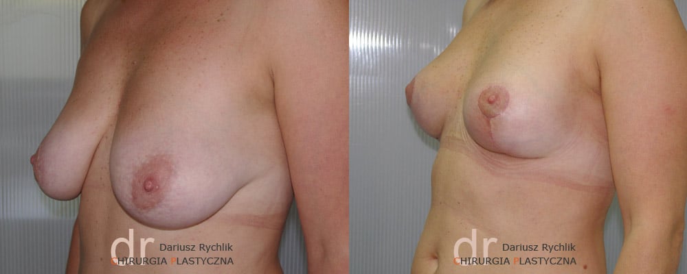 Podniesienie Piersi
 - Zabiegi piersi - Chirurgia Plastyczna Polanica