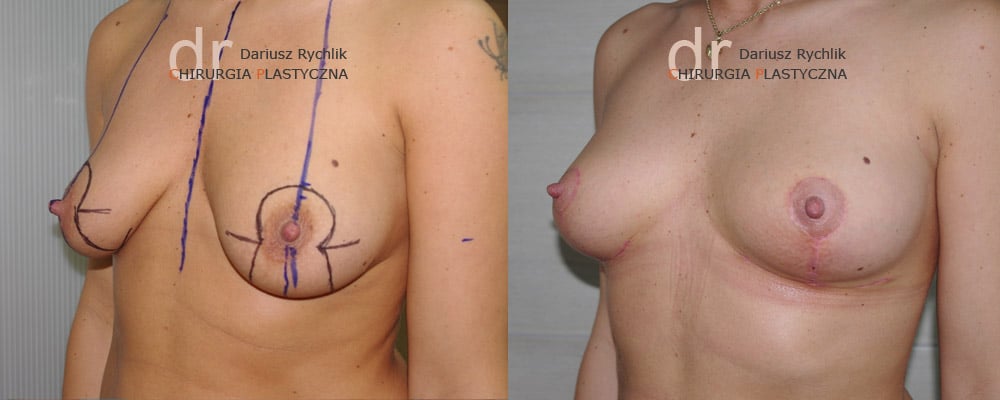 Podniesienie Piersi
 - Zabiegi piersi - Chirurgia Plastyczna Polanica