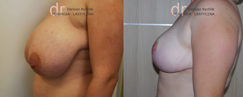 Zmniejszenie, redukcja piersiOperacja - Chirurgia Plastyczna Polanica - Chirplast