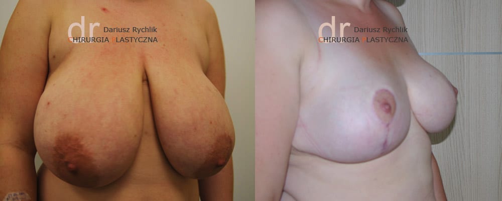 Zmniejszenie, redukcja piersiOperacja - Chirurgia Plastyczna Polanica - Chirplast