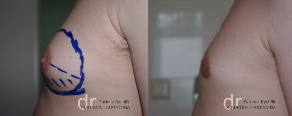 Ginekomastia - Zabiegi - Chirurgia Plastyczna Polanica