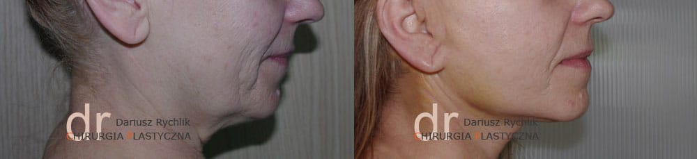 Plastyka twarzy i szyi Face Lifting - Operacja - Chirurgia Plastyczna Polanica - Chirplast