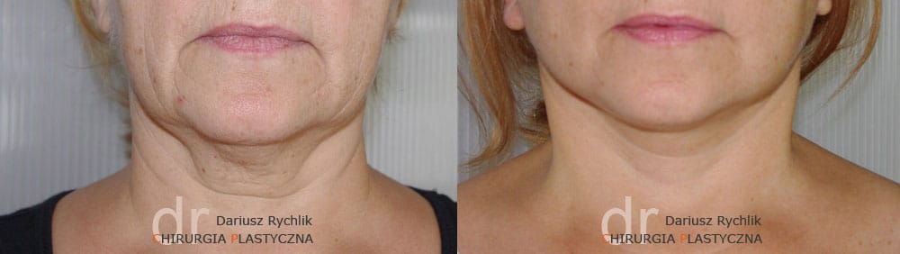 Plastyka twarzy i szyi Face Lifting - Operacja - Chirurgia Plastyczna Polanica - Chirplast