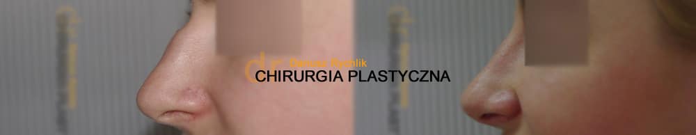 Plastyka uszu - Operacja -Chirurgia Plastyczna Polanica - Chirplast