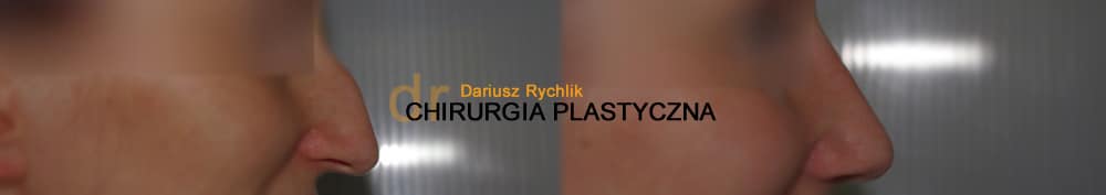 Plastyka uszu - Operacja -Chirurgia Plastyczna Polanica - Chirplast