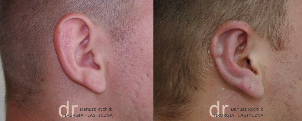 Plastyka uszu - Chirurgia Plastyczna Polanica - Chirplast