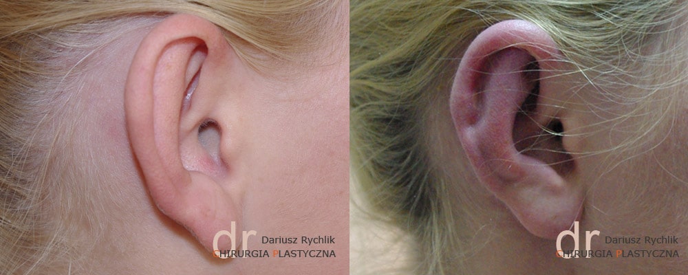 Plastyka uszu - Chirurgia Plastyczna Polanica - Chirplast
