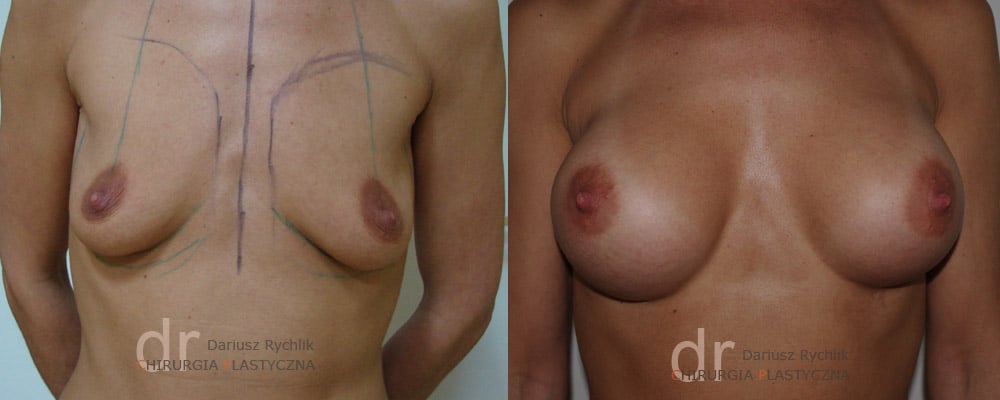 Powiększanie Piersi - Operacja biustu - Chirurgia Plastyczna Polanica