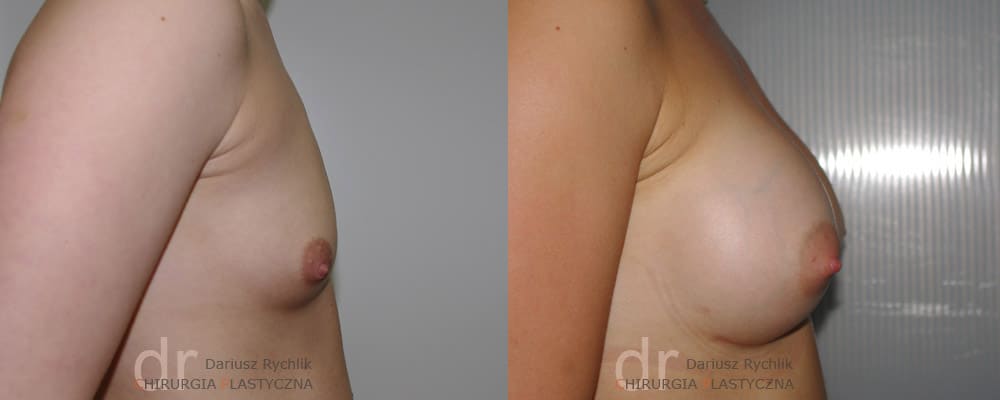 Powiększanie Piersi - Operacja biustu - Chirurgia Plastyczna Polanica